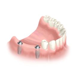 2 Implantate werden gesetzt